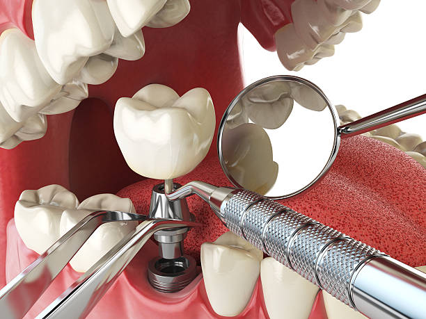Best Emergency Dentist for Lost Fillings or Crowns in Cary, IL